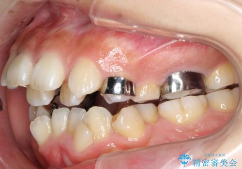 人生が変わる 困難を極める咬合状態に歯列矯正単独で挑戦するの治療中