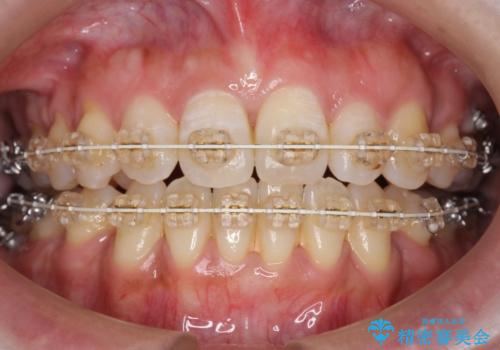 40代女性 前歯の重なり あきらめずに矯正の治療中