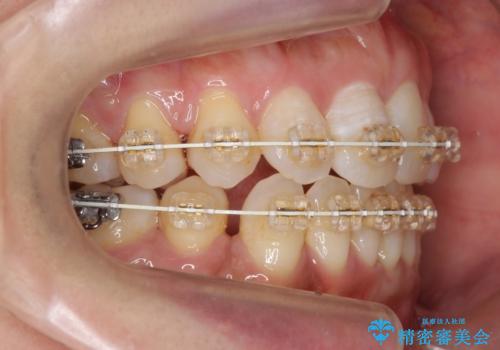 40代女性 前歯の重なり あきらめずに矯正の治療中
