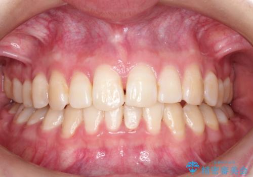 ハーフリンガル　ワイヤー矯正による非抜歯・過蓋咬合の治療の症例 治療後