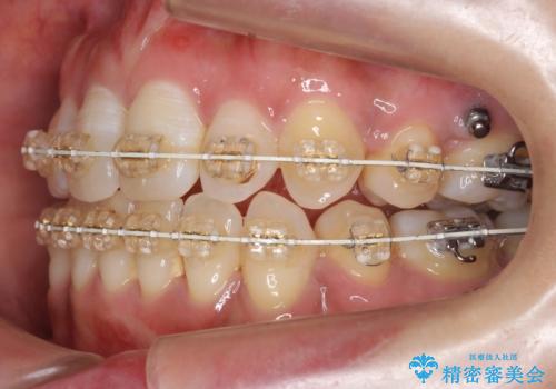 40代女性 前歯の重なり あきらめずに矯正の治療中