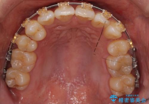 40代女性　前歯の重なり　あきらめずに矯正の治療中