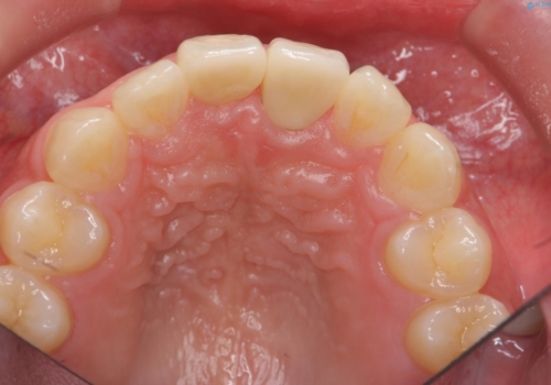 出っ歯をセラミックで治したい の治療後