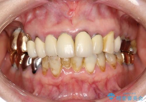 前歯の低クオリティな治療の実態 妥協無い治療で根本からやり治すの治療前