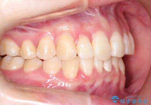 ハーフリンガル ワイヤー矯正による非抜歯・過蓋咬合の治療の治療後