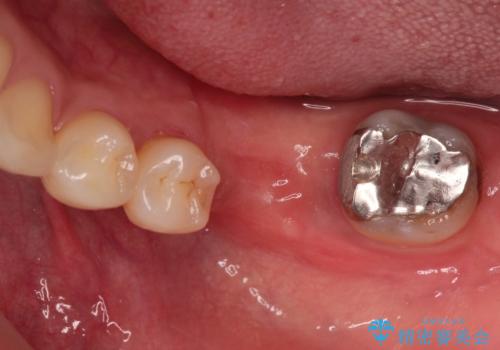 見えない歯周病 長期予後を見据えてインプラントにの治療中