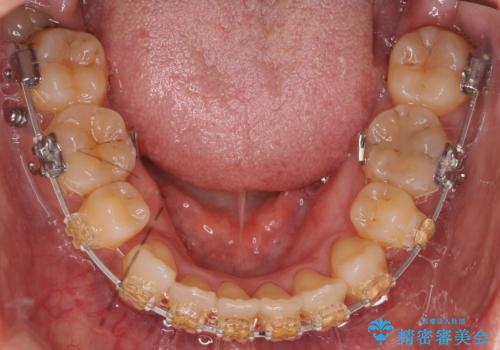 40代女性 前歯の重なり あきらめずに矯正の治療中