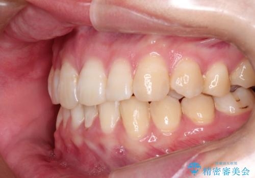 ハーフリンガル　ワイヤー矯正による非抜歯・過蓋咬合の治療の治療後