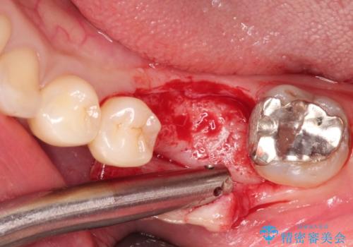 見えない歯周病 長期予後を見据えてインプラントにの治療中