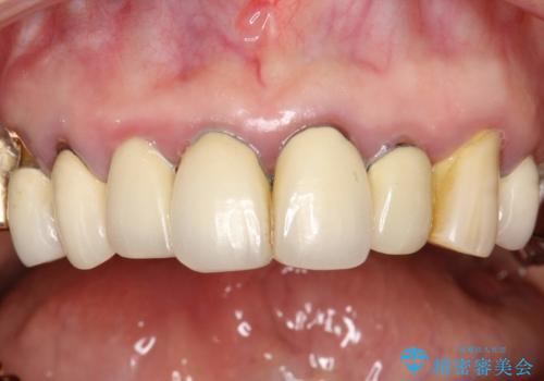 前歯の低クオリティな治療の実態 妥協無い治療で根本からやり治すの治療前