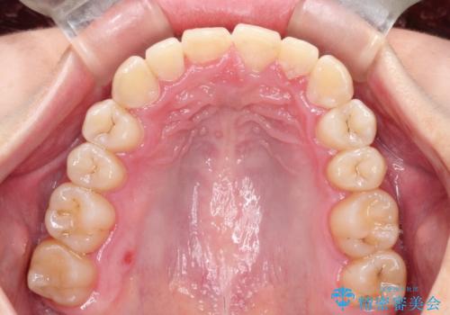 ハーフリンガル ワイヤー矯正による非抜歯・過蓋咬合の治療の治療後