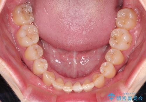 ハーフリンガル　ワイヤー矯正による非抜歯・過蓋咬合の治療の治療後