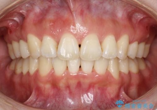 抜歯をして前歯を下げ、ガタつきを取り除く ワイヤー矯正の治療後