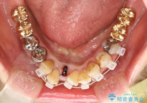 片顎の部分矯正 ワイヤーを用いて短期間でガタつきを改善するの治療中