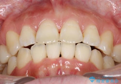 抜歯をして前歯を下げ、ガタつきを取り除く　ワイヤー矯正の治療後