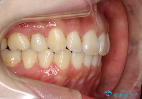 抜歯をして前歯を下げ、ガタつきを取り除く　ワイヤー矯正の治療後