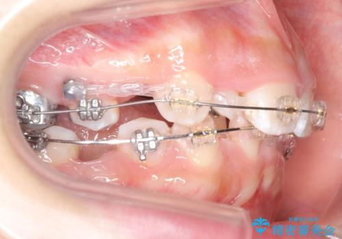 前歯のがたがた　前歯が内側に傾いているの治療中