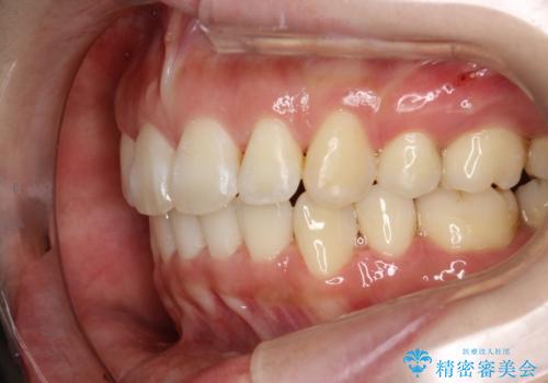 抜歯をして前歯を下げ、ガタつきを取り除く ワイヤー矯正の症例 治療後