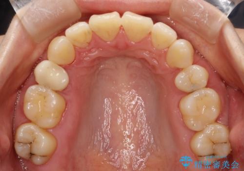 抜歯をして前歯を下げ、ガタつきを取り除く ワイヤー矯正の治療後