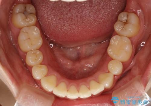 抜歯をして前歯を下げ、ガタつきを取り除く ワイヤー矯正の治療後