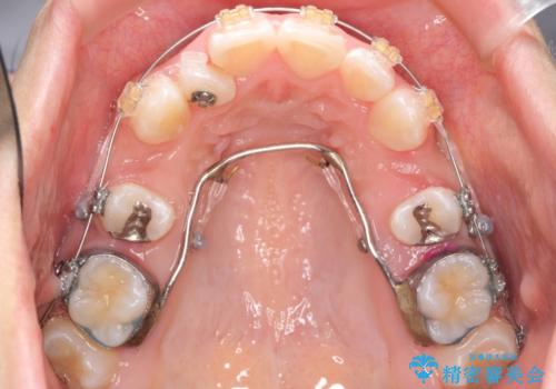 前歯のがたがた　前歯が内側に傾いているの治療中