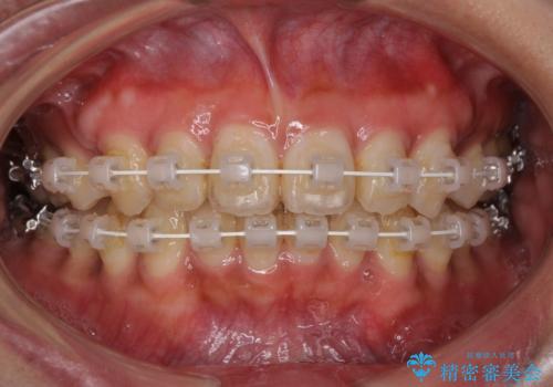 着色した歯肉のピーリング 黒ずみ除去の治療後