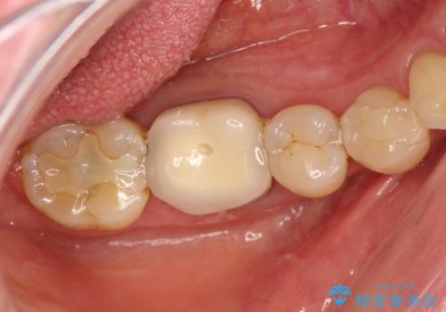 咬んだ時の違和感　顕微鏡で発見された歯の穴を処置し、かみ合わせを回復するの治療前