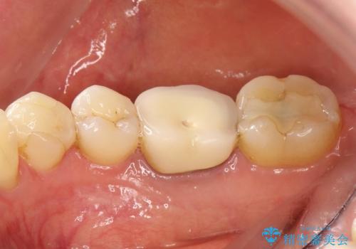 咬んだ時の違和感 顕微鏡で発見された歯の穴を処置し、かみ合わせを回復するの治療前