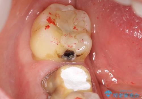 咬んだ時の違和感　顕微鏡で発見された歯の穴を処置し、かみ合わせを回復する
