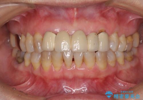 古くなった前歯のブリッジをオールセラミックにの治療前