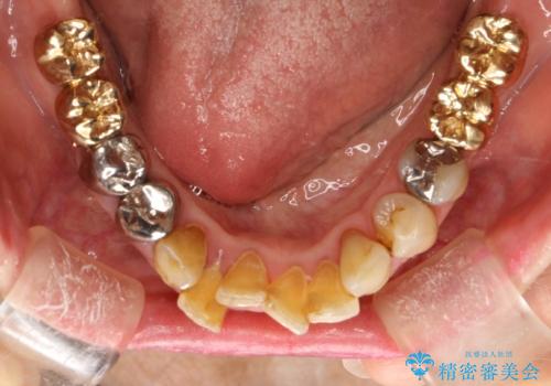 片顎の部分矯正 ワイヤーを用いて短期間でガタつきを改善するの治療前
