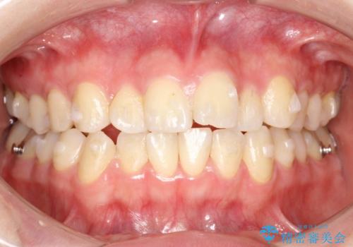 インビザラインによるガタつきの矯正治療 シンプル・短期間の治療中