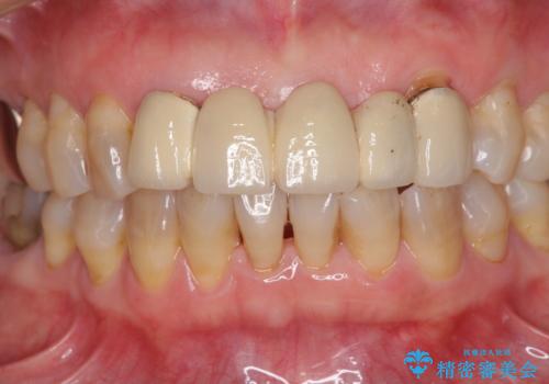 古くなった前歯のブリッジをオールセラミックにの治療前