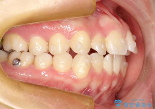 インビザラインによるガタつきの矯正治療 シンプル・短期間の治療中