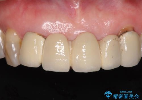 古くなった前歯のブリッジをオールセラミックにの治療前
