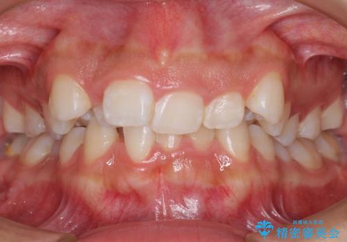 前歯のがたがた　前歯が内側に傾いているの症例 治療前