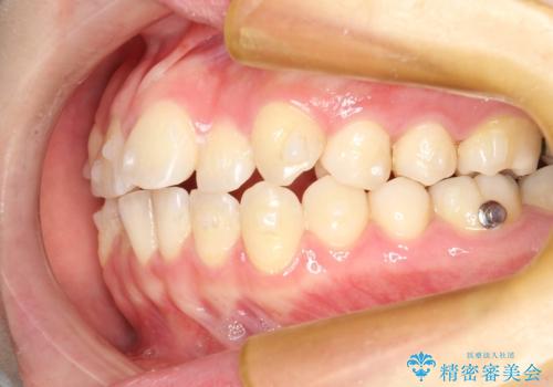 インビザラインによるガタつきの矯正治療 シンプル・短期間の治療中