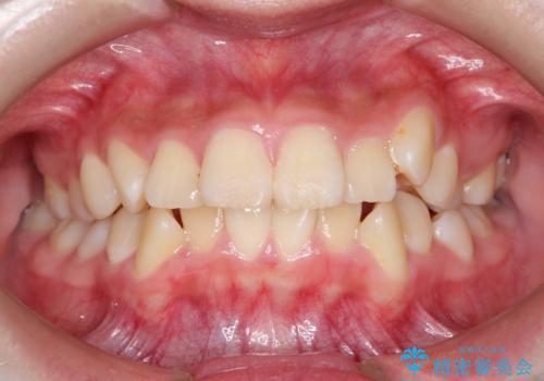 抜歯矯正で口元に変化を ラビアル・ワイヤー矯正でEラインの治療前