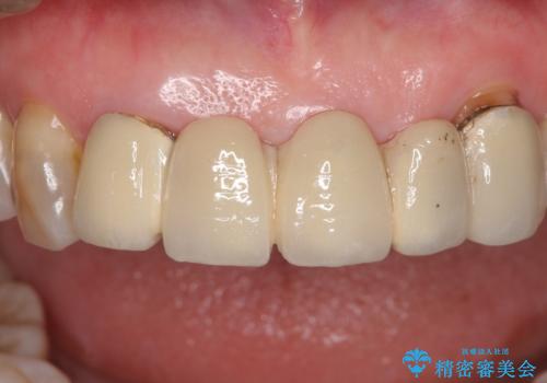 古くなった前歯のブリッジをオールセラミックにの治療前