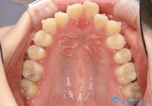 インビザラインによるガタつきの矯正治療 シンプル・短期間の治療中