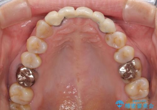 古くなった前歯のブリッジをオールセラミックにの治療前