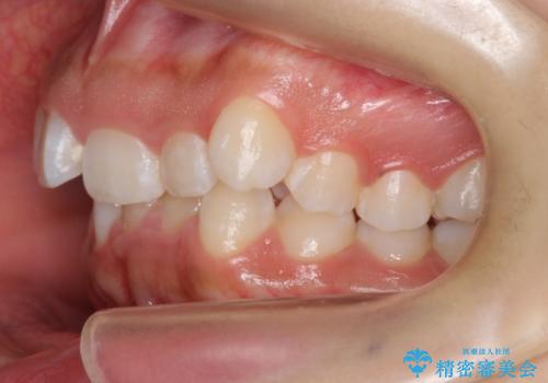 前歯のがたがた　前歯が内側に傾いているの治療前
