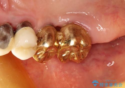 薄い骨にもインプラントを スプリットクレスト+ショートインプラントの応用の治療前