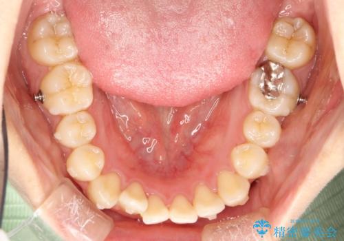 インビザラインによるガタつきの矯正治療 シンプル・短期間の治療中
