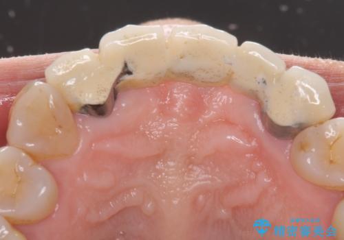 古くなった前歯のブリッジをオールセラミックにの治療前