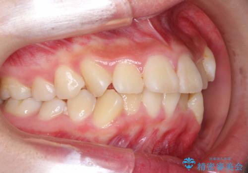 抜歯矯正で口元に変化を ラビアル・ワイヤー矯正でEラインの治療前