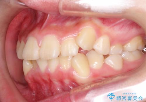抜歯矯正で口元に変化を ラビアル・ワイヤー矯正でEラインの症例 治療前