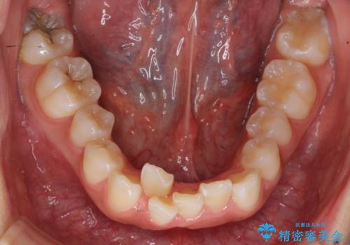 前歯のがたがた　前歯が内側に傾いているの治療前