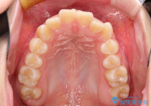 抜歯矯正で口元に変化を ラビアル・ワイヤー矯正でEラインの治療前