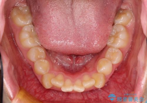 抜歯矯正で口元に変化を ラビアル・ワイヤー矯正でEラインの治療前